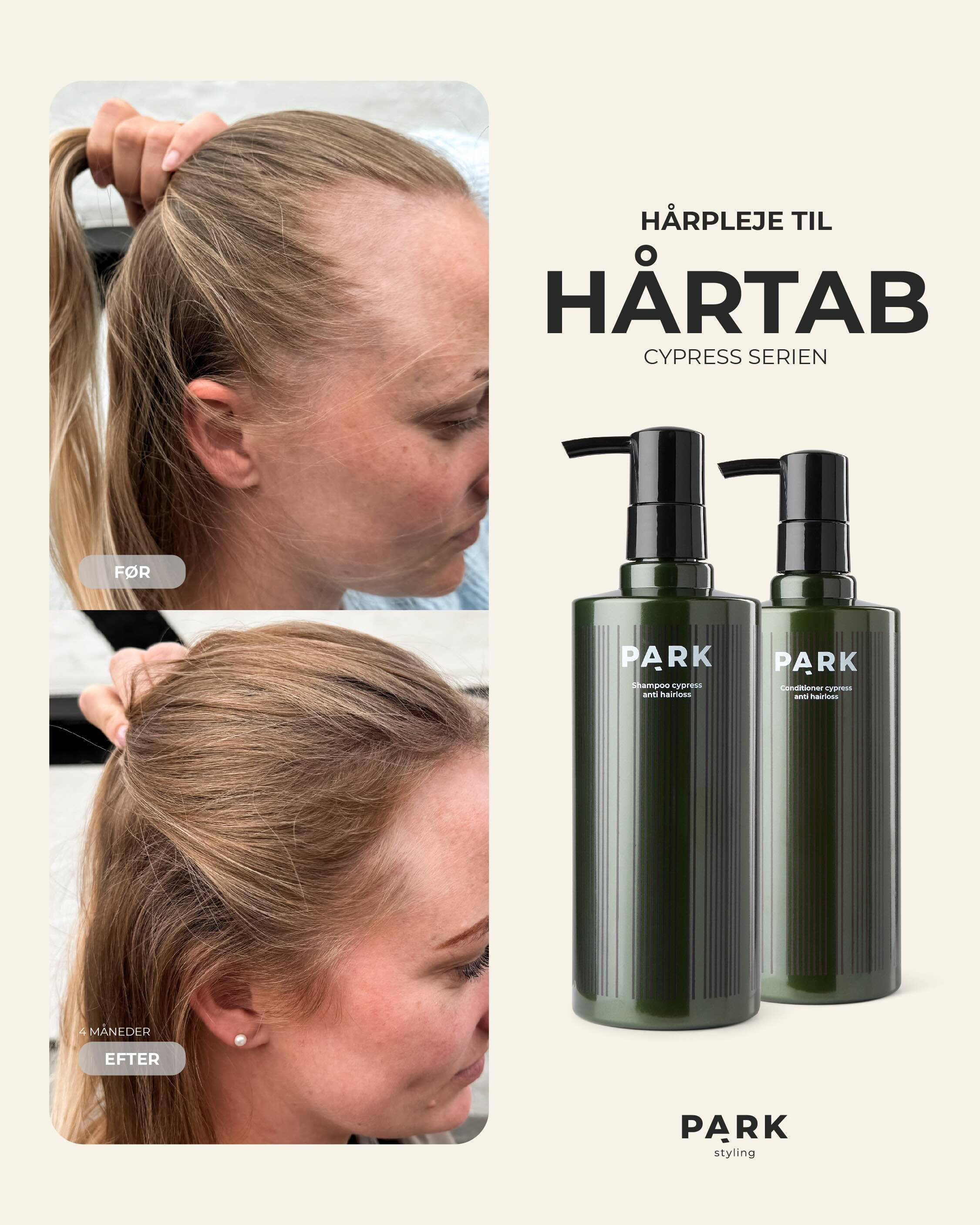 Hårtab? Miriams oplevelse med Cypress-serien